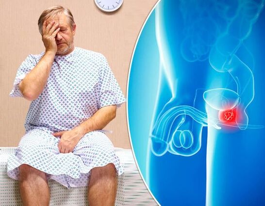 Symptoms of prostatitis
