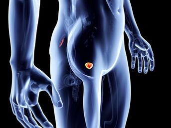 Inflammatory process in the prostate with prostatitis