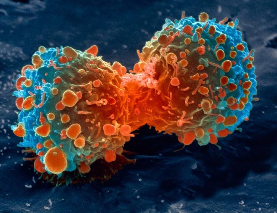 Tumor cell as a complication of prostatitis