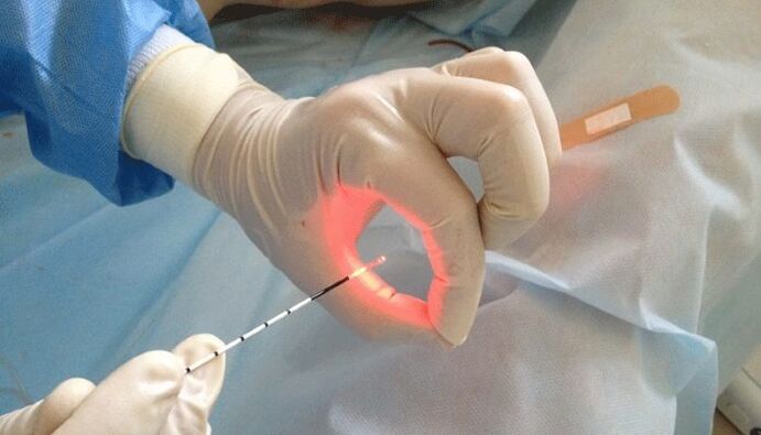 Laser treatment for prostatitis