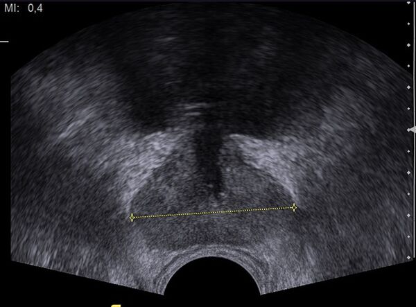 healthy prostate on ultrasound after taking Predstonorm